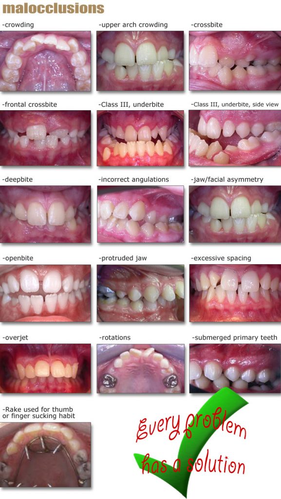 Common Orthodontic Problems Yeh Orthodontics